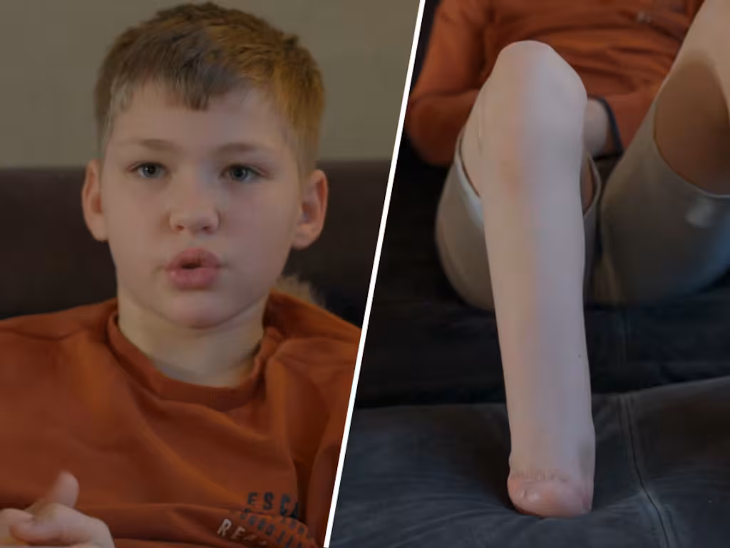 Sven toont zijn been zonder prothese