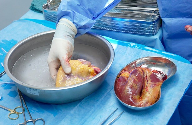 Warten auf ein neues Herz - Patienten, Transplantationsärzte und der Faktor Zeit