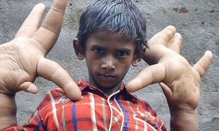 Shock Doc: De jongen met de reuzenhanden