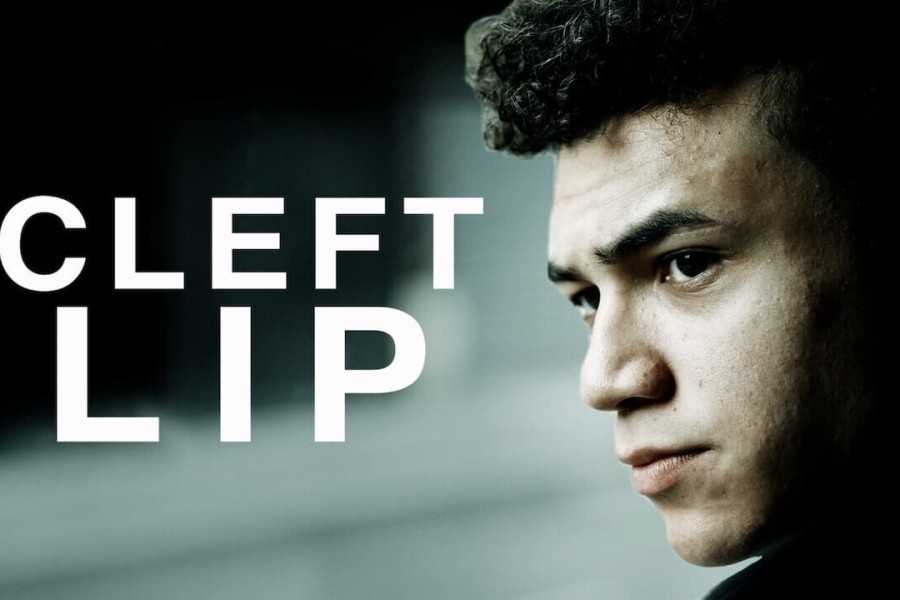 Cleft Lip